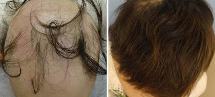 alopekia-708_0.jpg