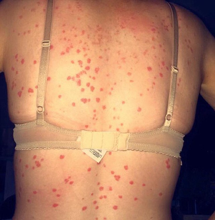 derma5