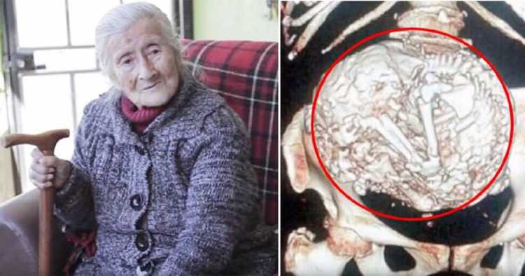 Μια 91χρονη γυναίκα κουβαλούσε για 60 χρόνια στην κοιλιά της το νεκρό μωρό της