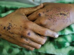 The hands of a man injured during Saturday’s apparent Saudi-led air strike on a community hall, are seen while he lays on a hospital bed in the capital Sanaa, Yemen