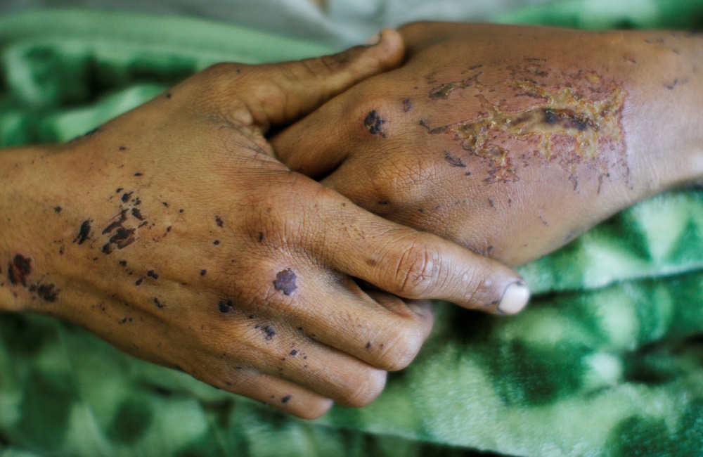 Κρούσματα χολέρας στο Ιράκ – Αναζωπύρωση της μολυσματικής ασθένειας