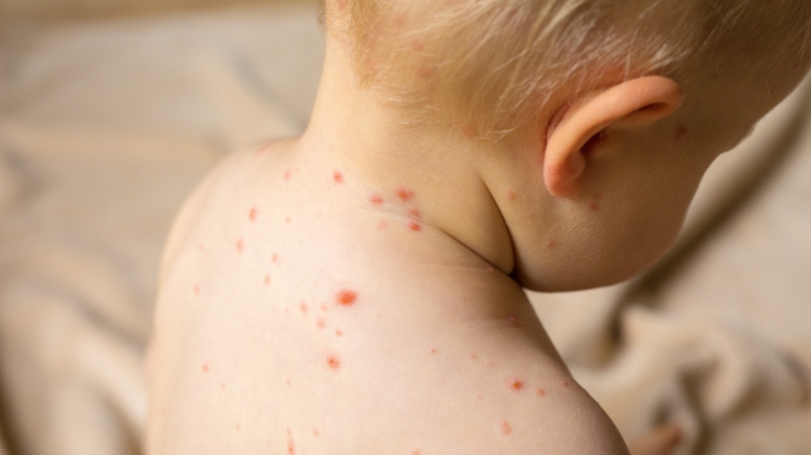 Δρ. Ηλίας: Έξαρση ιλαράς στην Ευρώπη, να εμβολιαστούν τα παιδιά