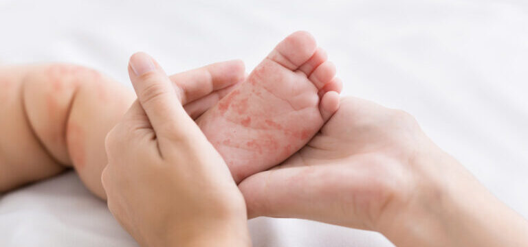 measles_ilara_1391758724-768×432