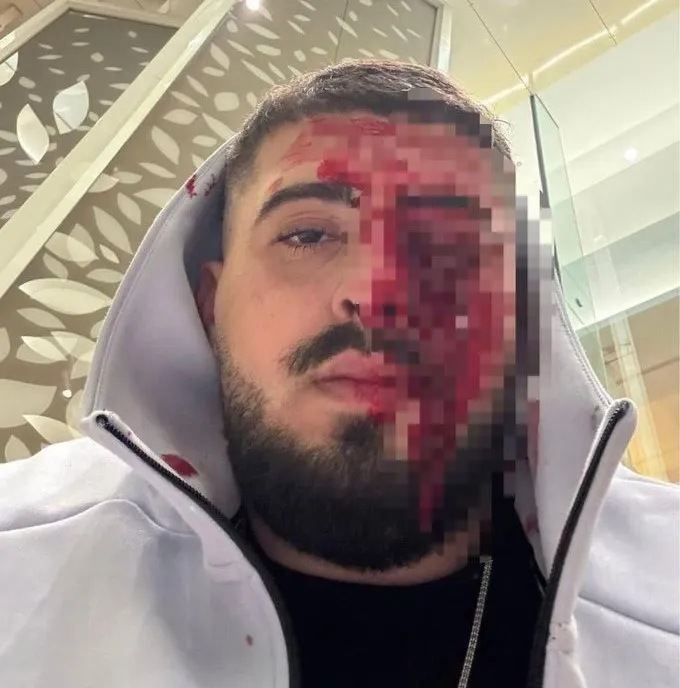 Καταγγελία Ισραηλινού Λεμεσό: «Τον ξυλοκόπησαν μέχρι λιποθυμίας»