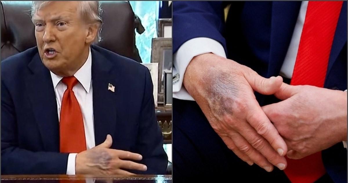 Ο Τραμπ εξήγησε τον λόγο που έχει μώλωπες στα χέρια