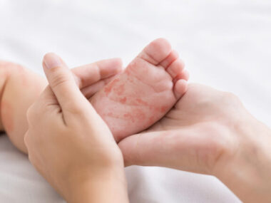 measles_ilara_1391758724-768×432