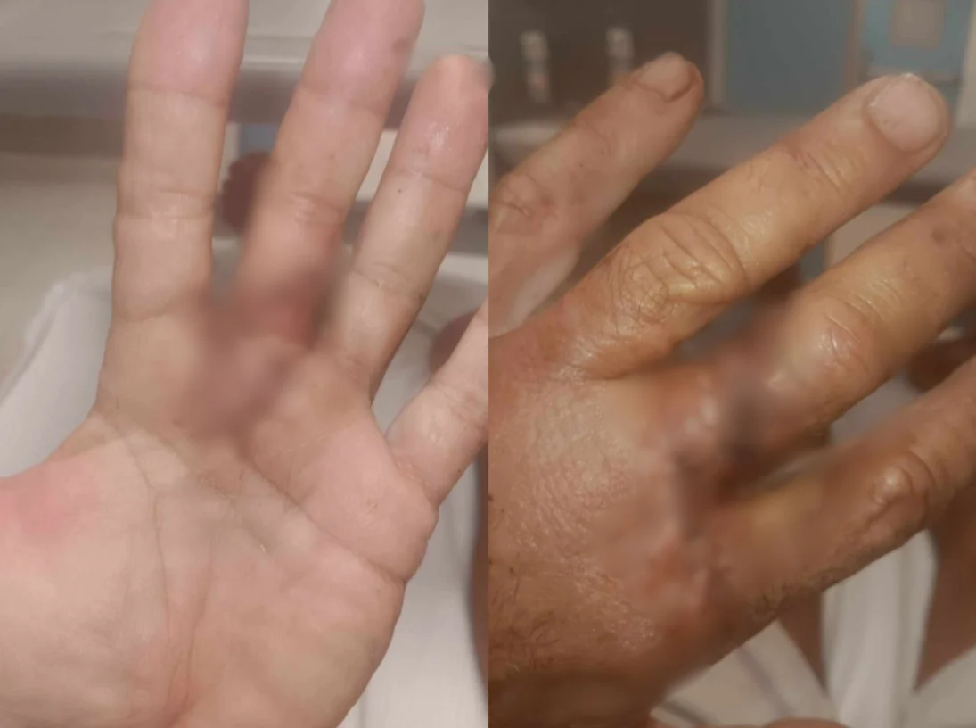 Πήγε για κολύμπι και κατέληξε με 26 ράμματα στο δάχτυλο – «Ήταν λαγοκέφαλος»